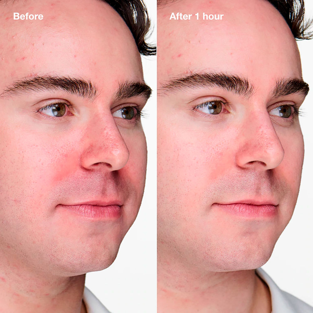 ANTI BLEMISH Solutions Clinical gel anti imperfections avancé 20 ml - vue 2