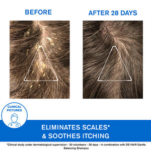 Ds Hair Shampoo for Severe Dandruff with 1.8% Lactic Acid