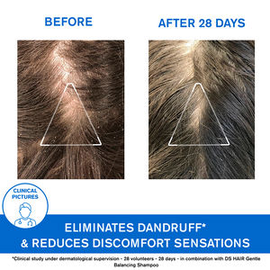 Ds Moderate Dandruff Shampoo with Piroctone Olamine - Eliminates Dry and Oily Dandruff