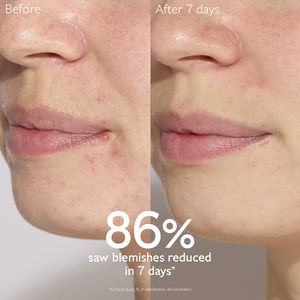 VINOPURE anti-blemish serum