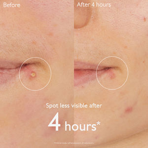 VINOPURE stop boutons salicylique