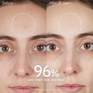KIT ROUTINE ANTI-ACNE VINOPURE