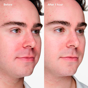 ANTI-BLEMISH SOLUTIONS CLINICAL gel avanzado anti-imperfecciones