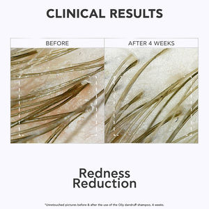 DANDRUFF RELIEF champú dermatológico para caspa grasa​