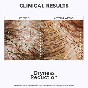 DANDRUFF RELIEF dermatological scalp lotion with immediate calming effect